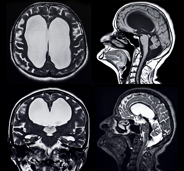 Hydrocephalus