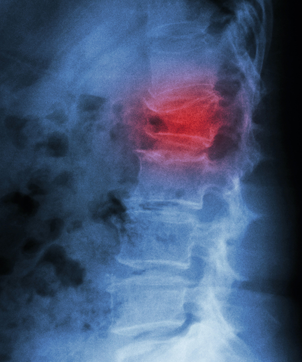 image of a break in the spine